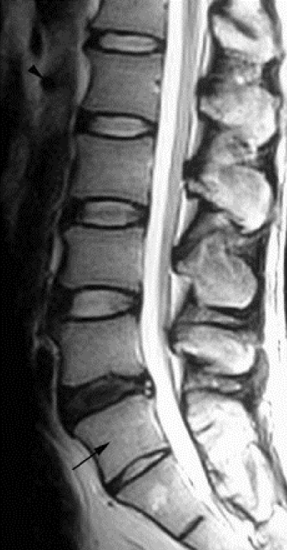 Herniated disk
